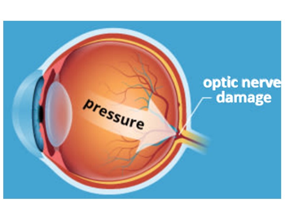 Sight - Glaucoma